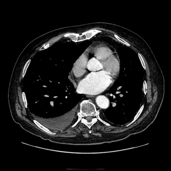 File:Bronchogenic adenocarcinoma and pulmonary embolism (Radiopaedia 9097-9806 D 39).jpg
