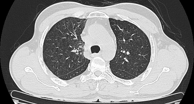 File:Bronchogenic carcinoma with superior vena cava syndrome (Radiopaedia 36497-38054 Axial lung window 35).jpg