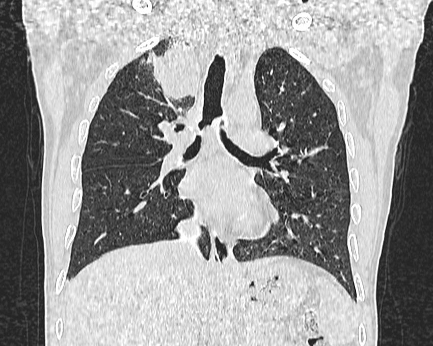 Bronchogenic carcinoma with superior vena cava syndrome (Radiopaedia 36497-38054 Coronal lung window 42).jpg
