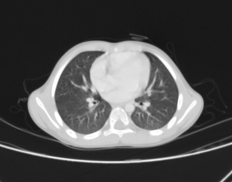 File:Bronchus suis (Radiopaedia 68131-77620 Axial lung window 51).jpg