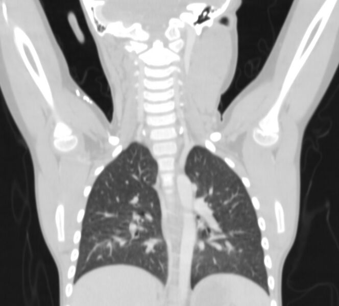 File:Bronchus suis (Radiopaedia 68131-77620 Coronal lung window 24).jpg