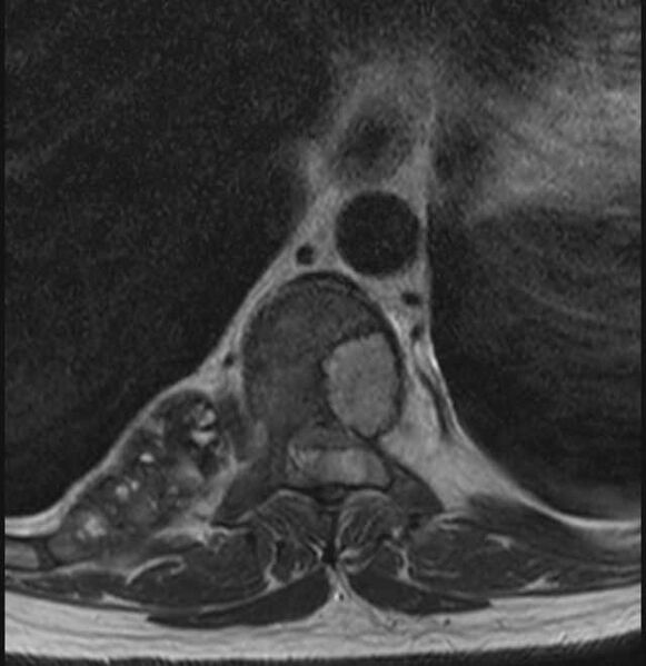 File:Brown tumors compressing the spinal cord (Radiopaedia 68442-78030 A 16).jpg