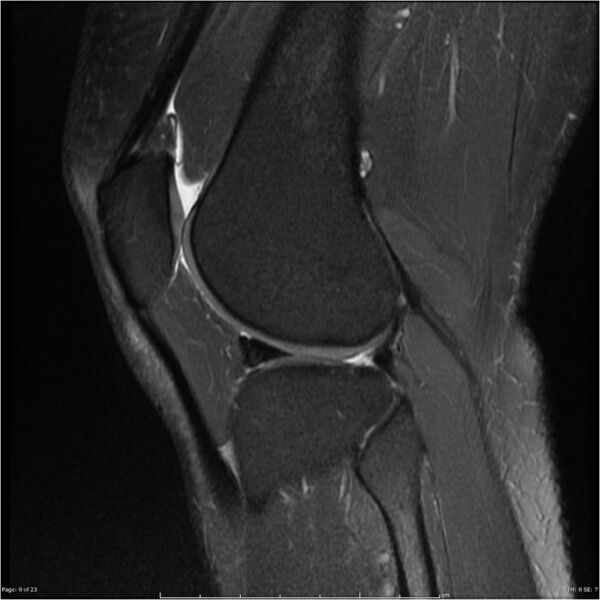File:Bucket handle tear - lateral meniscus (Radiopaedia 7246-8187 Sagittal T2 fat sat 8).jpg