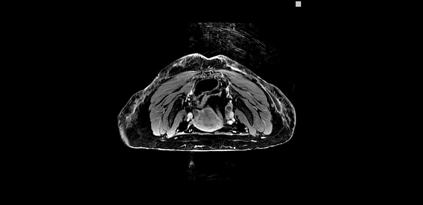 Buttock filler complications (Radiopaedia 63497-72115 Axial T1 C+ 7).jpg