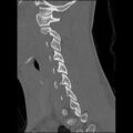 C5 facet fracture (Radiopaedia 58374-65499 Sagittal bone window 46).jpg