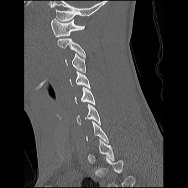 File:C5 facet fracture (Radiopaedia 58374-65499 Sagittal bone window 46).jpg