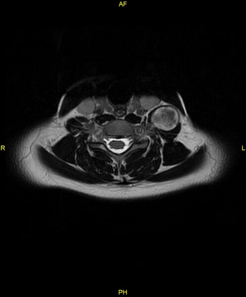 File:C5 nerve sheath tumor (Radiopaedia 85777-101596 Axial T2 47).jpg