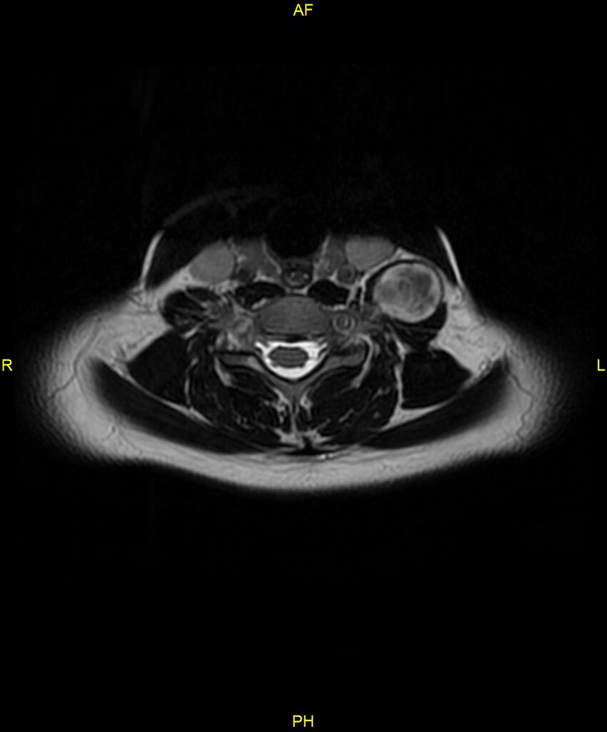 C5 nerve sheath tumor (Radiopaedia 85777-101596 Axial T2 47).jpg