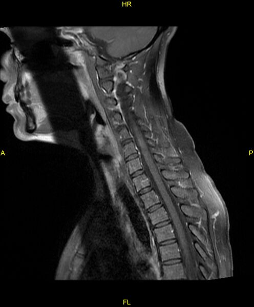 File:C5 nerve sheath tumor (Radiopaedia 85777-101596 F 9).jpg