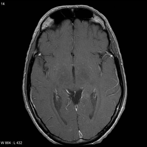 File:CMV ventriculitis and encephalitis (Radiopaedia 5416-7166 Axial T1 C+ 3).jpg