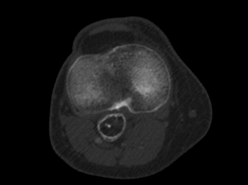 File:Calcified hematoma - popliteal fossa (Radiopaedia 63938-72763 C 36).jpg