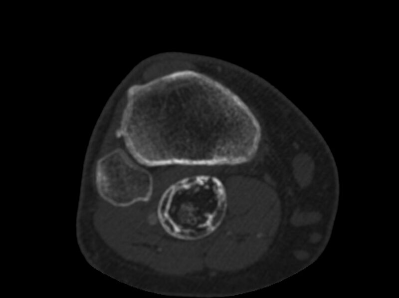 File:Calcified hematoma - popliteal fossa (Radiopaedia 63938-72763 C 67).jpg