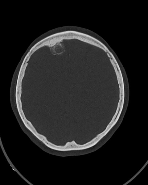 File:Calcified meningioma (Radiopaedia 74361-85243 Axial bone window 13).jpg