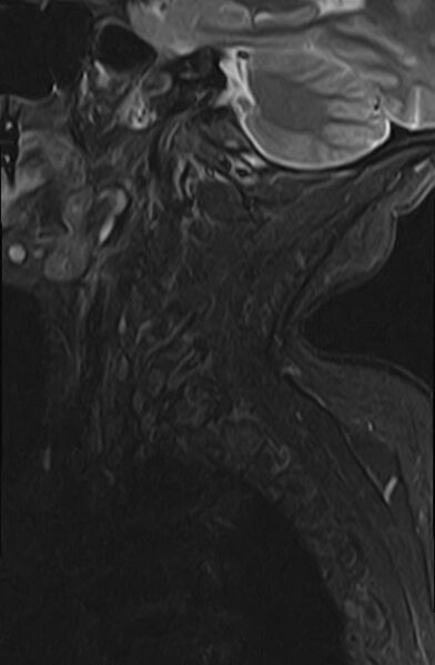 File:Calcified meningioma - cervical canal (Radiopaedia 70136-82468 Sagittal STIR 2).jpg