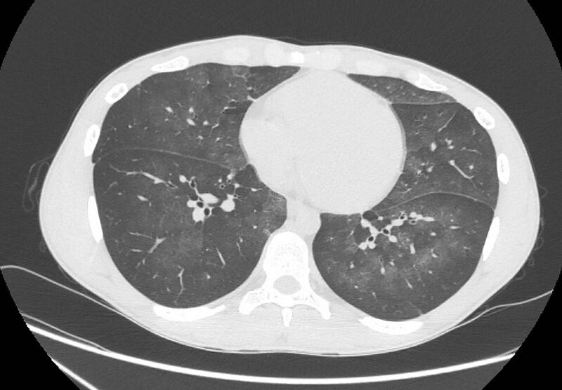 File:Cannabis-induced diffuse alveolar hemorrhage (Radiopaedia 89834-106946 Axial lung window 75).jpg