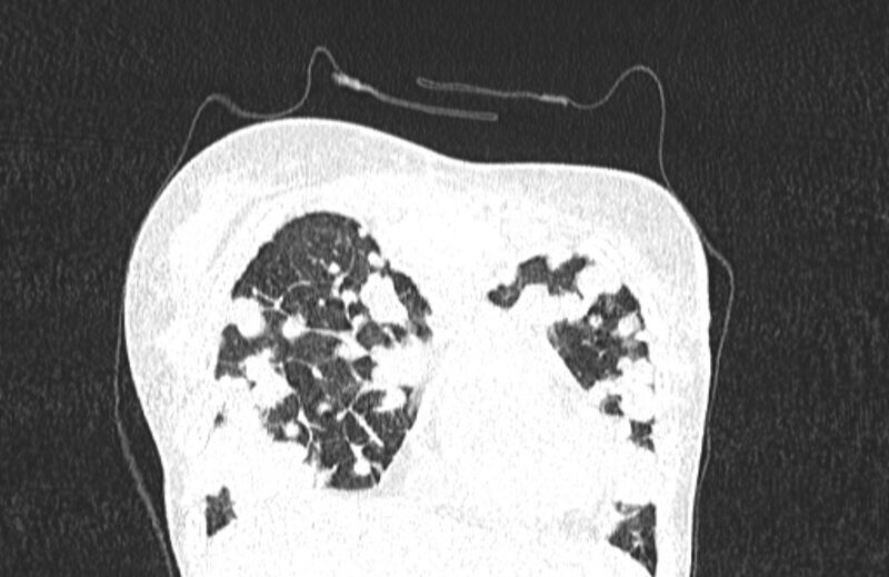 File:Cannonball metastases from breast cancer (Radiopaedia 91024-108569 Coronal lung window 23).jpg