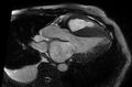 Cardiac amyloidosis (Radiopaedia 61600-69579 B 3).jpg