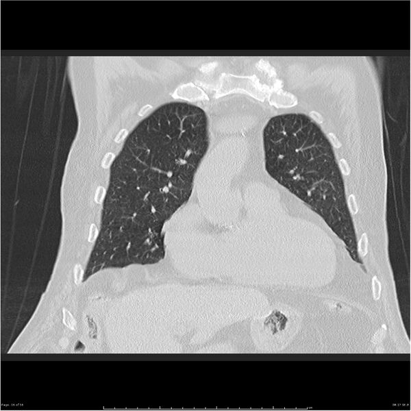 File:Cavitating left lower lobe lesion - squamous cell lung cancer (Radiopaedia 27749-28176 Coronal lung window 16).jpg