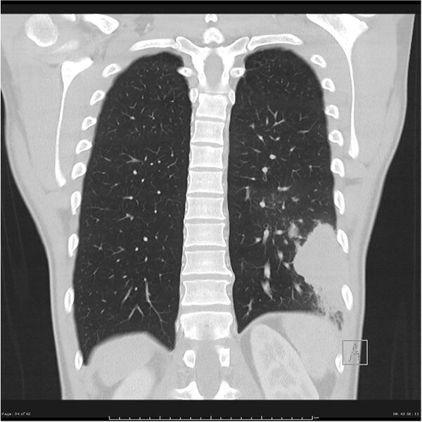 File:Cavitating lung cancer (Radiopaedia 25796-25945 lung window 34).jpg