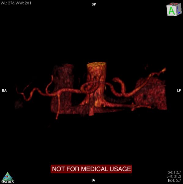 File:Celiac trunk variant anatomy - gastrohepatic trunk and splenic artery (Radiopaedia 38815-40995 B 15).jpg