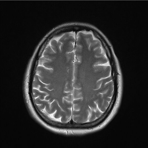 File:Central base of skull meningioma (Radiopaedia 53531-59549 Axial T2 15).jpg