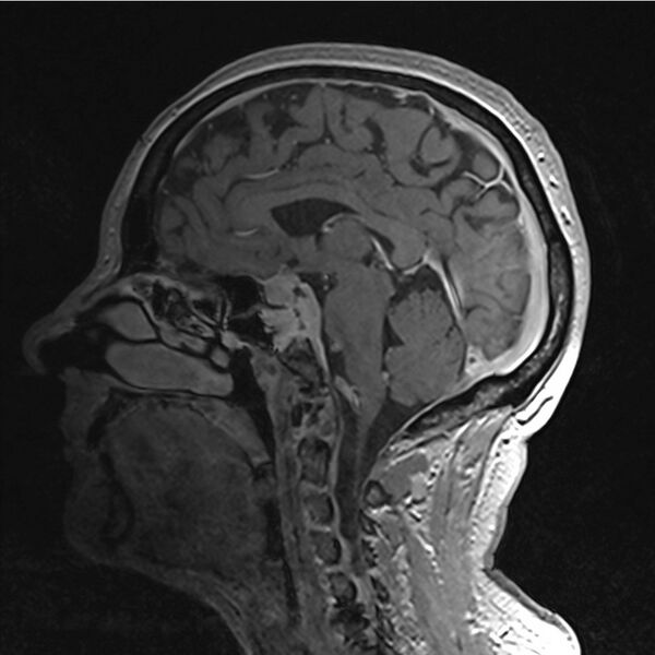 File:Central base of skull meningioma (Radiopaedia 53531-59549 Sagittal T1 C+ 28).jpg
