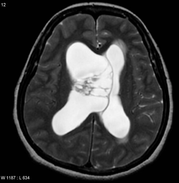 File:Central neurocytoma (Radiopaedia 4355-6613 Axial T2 1).jpg