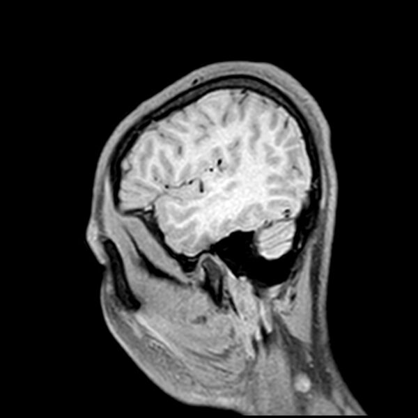 File:Central neurocytoma (Radiopaedia 79320-92380 Sagittal T1 213).jpg