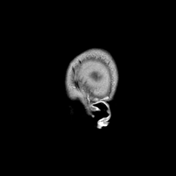 File:Central neurocytoma (Radiopaedia 79320-92380 Sagittal T1 256).jpg