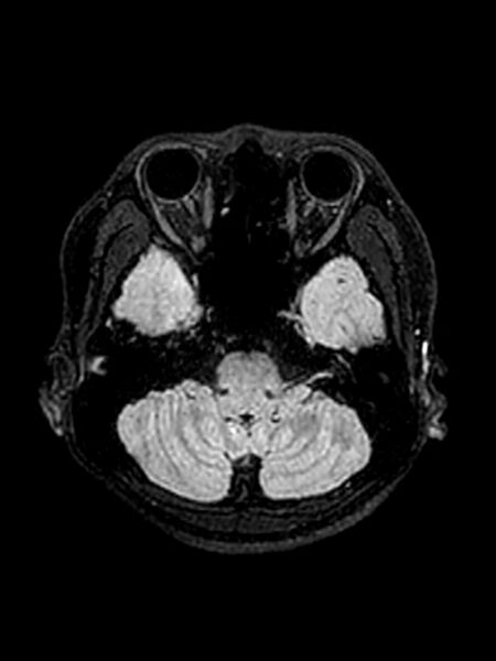 File:Central neurocytoma (Radiopaedia 79320-92381 Axial FLAIR 126).jpg
