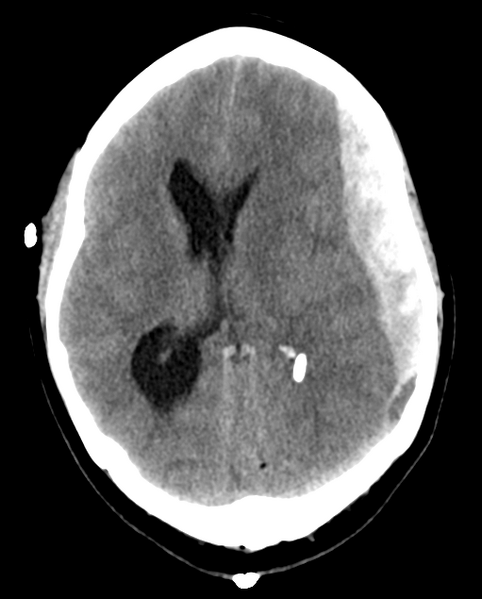 File:Cerebellar ependymoma complicated by post-operative subdural hematoma (Radiopaedia 83322-97737 Axial non-contrast 15).png