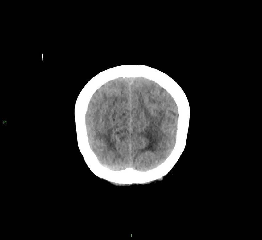 Cerebellar hemorrhage (Radiopaedia 58793-66027 Coronal non-contrast 14).jpg