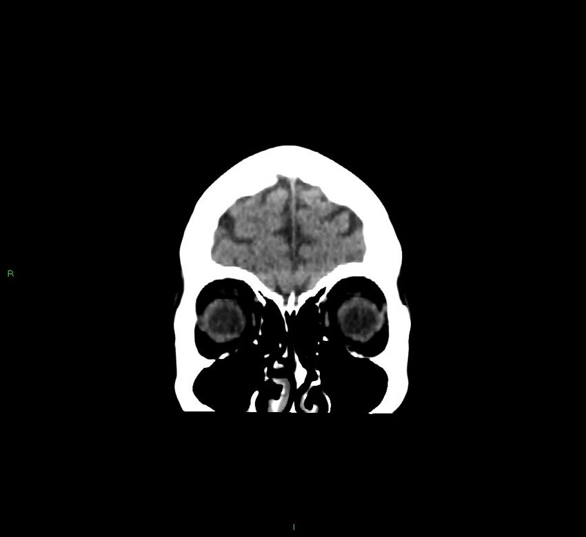 Cerebellar hemorrhage (Radiopaedia 58793-66027 Coronal non-contrast 57).jpg