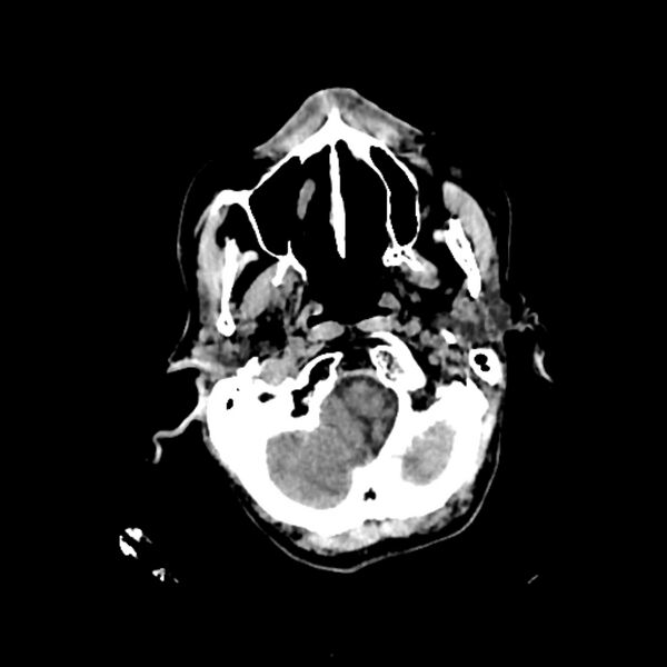 File:Cerebellar metastasis - lung tumor (Radiopaedia 69317-79145 Axial non-contrast 2).jpg