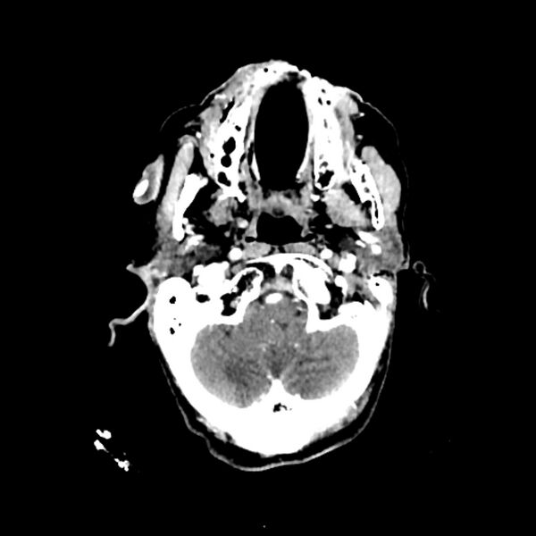 File:Cerebellar metastasis - lung tumor (Radiopaedia 69317-79145 Axial with contrast 5).jpg