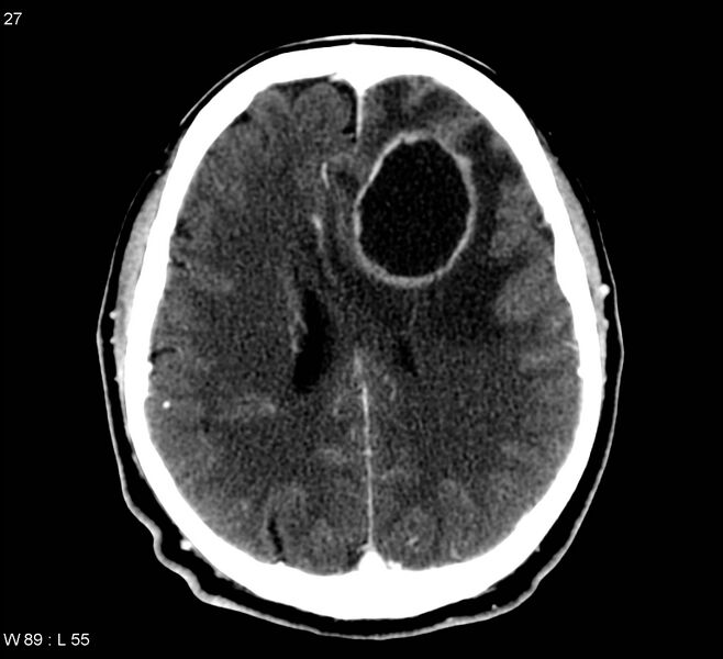 File:Cerebral abscess (Radiopaedia 5150-6932 C+ delayed 1).jpg