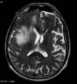 Cerebral abscesses secondary to contusions (Radiopaedia 5201-6968 Axial T2 1).jpg