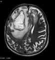 Cerebral abscesses secondary to contusions (Radiopaedia 5201-6968 Axial T2 5).jpg