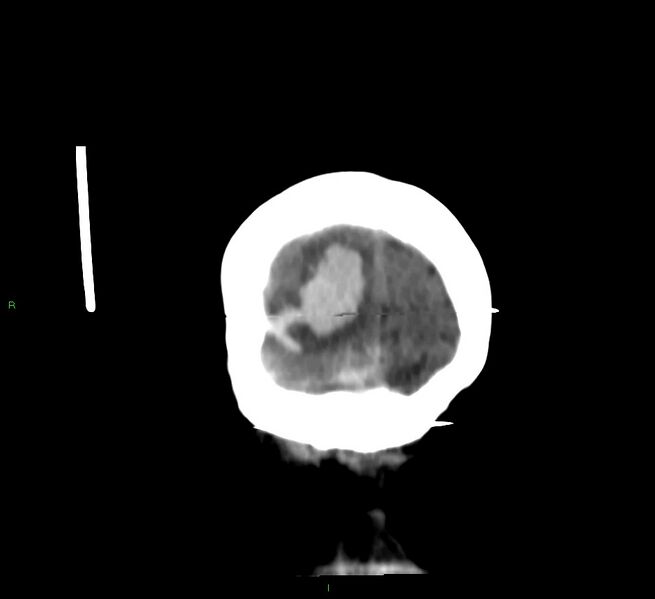 File:Cerebral amyloid angiopathy-associated lobar intracerebral hemorrhage (Radiopaedia 58377-65514 Coronal non-contrast 8).jpg