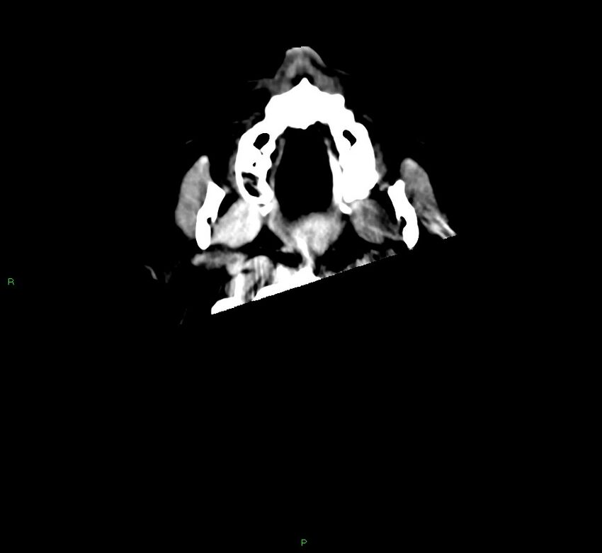 Cerebral amyloid angiopathy-associated lobar intracerebral hemorrhage (Radiopaedia 58560-65723 Axial non-contrast 55).jpg