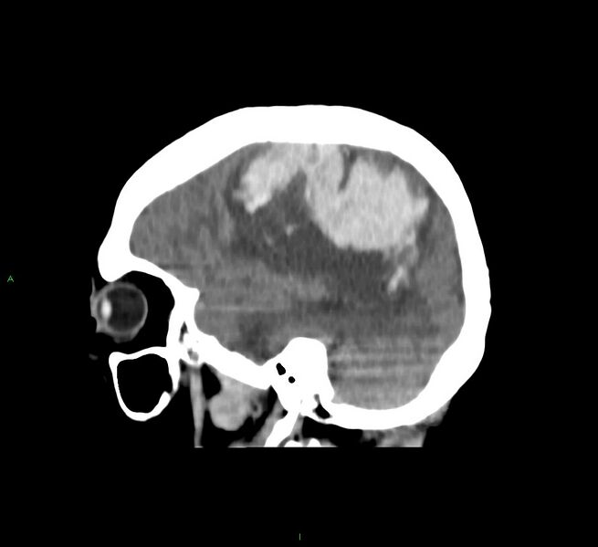 File:Cerebral amyloid angiopathy-associated lobar intracerebral hemorrhage (Radiopaedia 58751-65972 C 17).jpg
