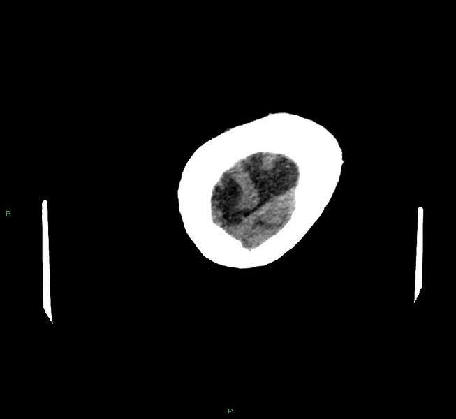 File:Cerebral amyloid angiopathy-associated lobar intracerebral hemorrhage (Radiopaedia 58757-65979 Axial non-contrast 136).jpg