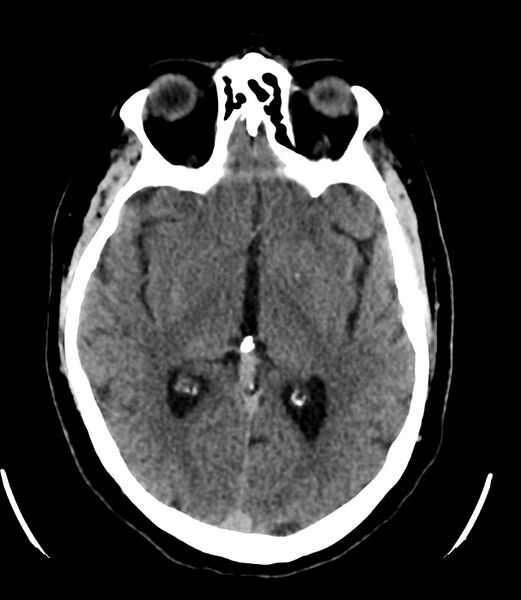 File:Cerebral dural venous sinus thrombosis (Radiopaedia 86514-102575 Axial non-contrast 21).jpg