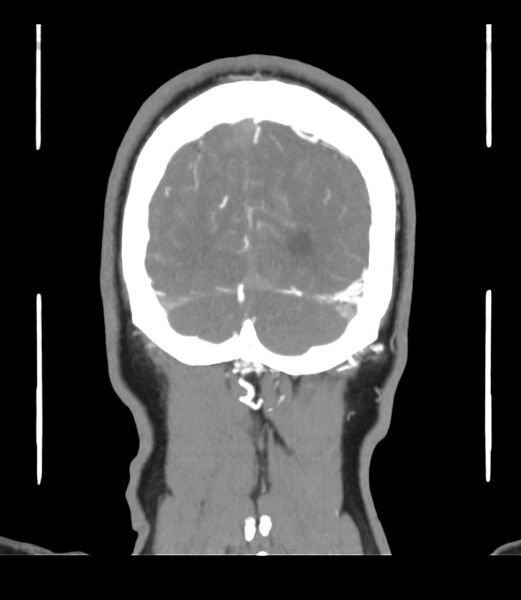 File:Cerebral dural venous sinus thrombosis (Radiopaedia 86514-102576 B 67).jpg