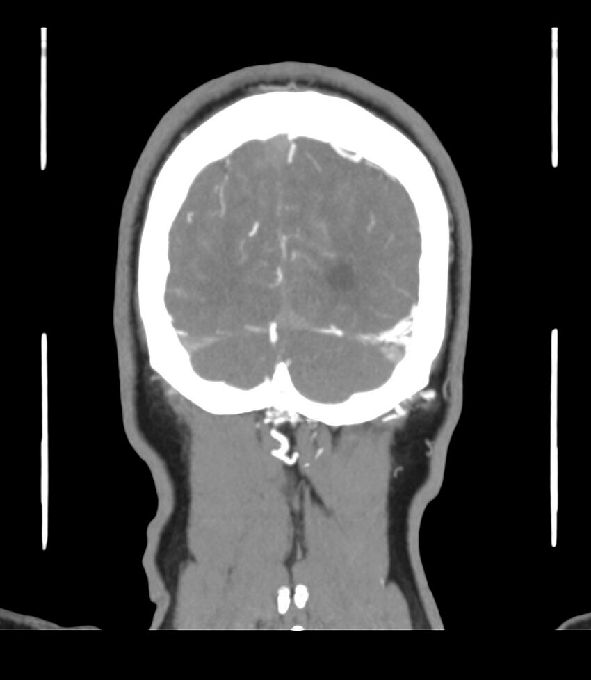 Cerebral dural venous sinus thrombosis (Radiopaedia 86514-102576 B 67).jpg