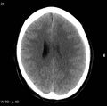 Cerebral hemorrhagic contusion with subdural and subarachnoid hemorrhage (Radiopaedia 10680-11146 Axial non-contrast 17).jpg