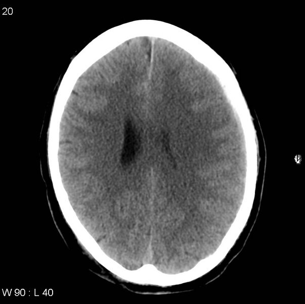 File:Cerebral hemorrhagic contusion with subdural and subarachnoid hemorrhage (Radiopaedia 10680-11146 Axial non-contrast 17).jpg