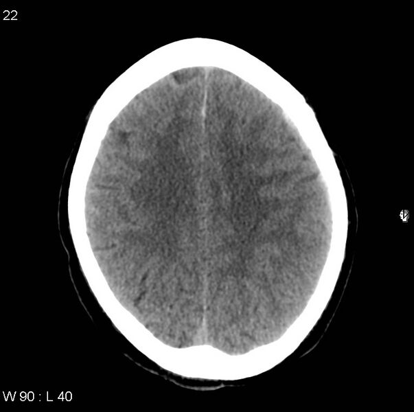 File:Cerebral hemorrhagic contusion with subdural and subarachnoid hemorrhage (Radiopaedia 10680-11146 Axial non-contrast 19).jpg
