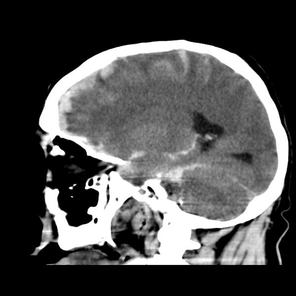 File:Cerebral hemorrhagic contusions (Radiopaedia 23145-23188 C 28).jpg