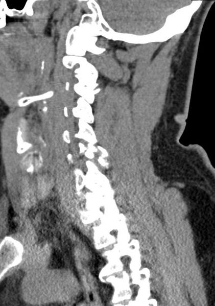 File:Cerebral hemorrhagic contusions and cervical spine fractures (Radiopaedia 32865-33841 G 47).jpg